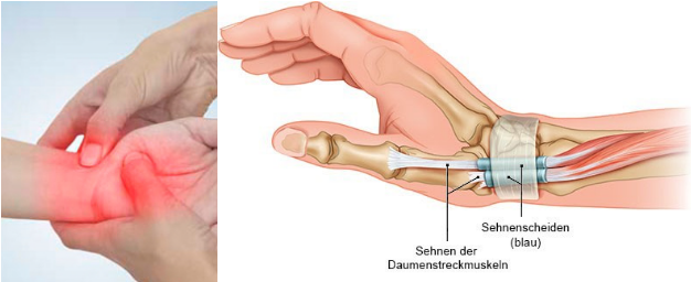 Krücken Handschmerzen – muss man damit leben?